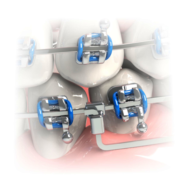 Cervical Offset Cross Tube