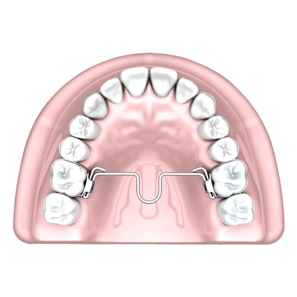 Palatal Arch Bars