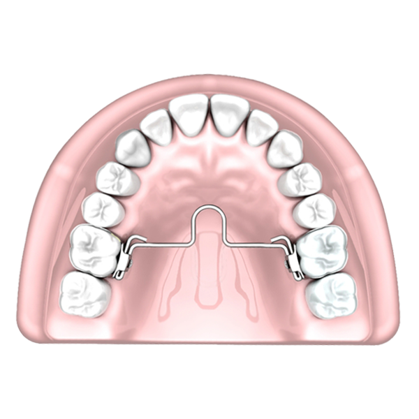 Palatal Arch Bars